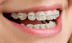  Ceramic braces