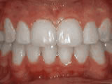  Crowding of the teeth