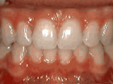  Deep overbite - Lower front teeth bite into palate