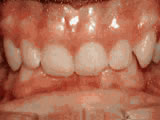  Deep overbite - Lower front teeth bite into palate