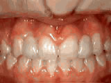  Missing lateral incisors