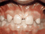  Missing lateral incisors