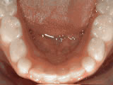  Non-braces treatment