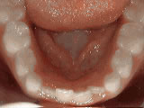  Non-braces treatment