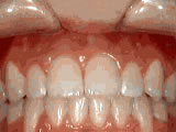  Open bite - Front teeth don't touch