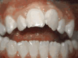  Open bite - Front teeth don't touch