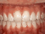  Overjet - Protruding front teeth