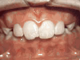  Overjet - Protruding front teeth