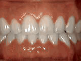  Spacing of teeth
