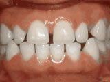  Spacing of teeth