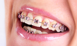  Metal braces