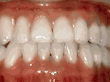  Underbite - Lower front teeth in front of upper teeth