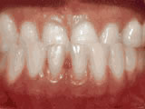  Underbite - Lower front teeth in front of upper teeth